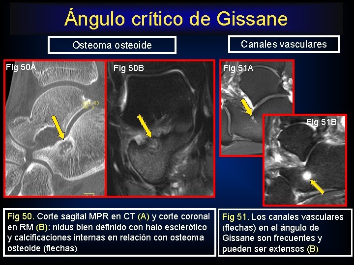 Ángulo crítico de Gissane Osteoma osteoide Fig 50 A Fig 50 B Canales vasculares