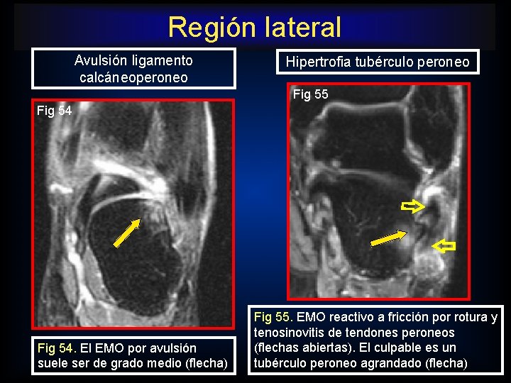 Región lateral Avulsión ligamento calcáneoperoneo Hipertrofia tubérculo peroneo Fig 55 Fig 54. El EMO