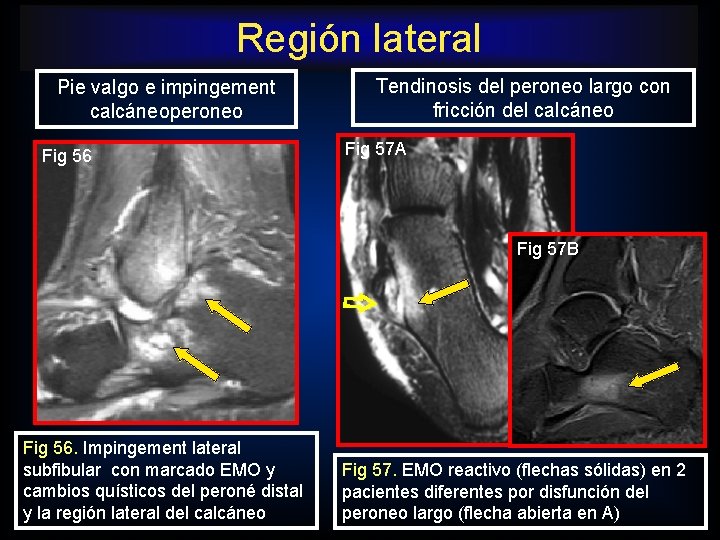 Región lateral Pie valgo e impingement calcáneoperoneo Fig 56 Tendinosis del peroneo largo con