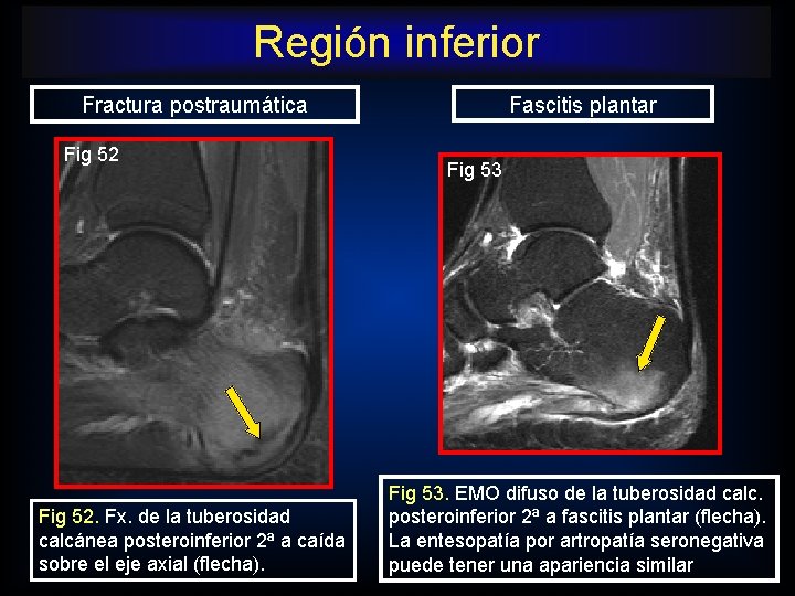 Región inferior Fascitis plantar Fractura postraumática Fig 52. Fx. de la tuberosidad calcánea posteroinferior