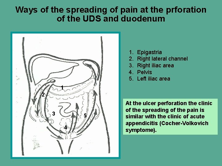 Ways of the spreading of pain at the prforation of the UDS and duodenum