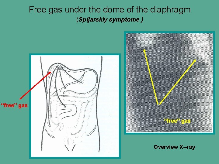 Free gas under the dome of the diaphragm (Spijarskiy symptome ) “free” gas Overview Free gas under the dome of the diaphragm (Spijarskiy symptome ) “free” gas Overview