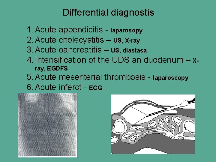 Differential diagnostis 1. Acute appendicitis - laparosopy 2. Acute cholecystitis – US, X-ray 3.