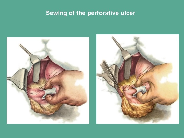 Sewing of the perforative ulcer 