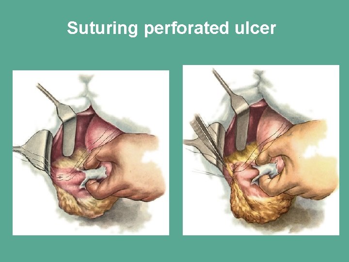 Suturing perforated ulcer 