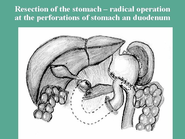 Resection of the stomach – radical operation at the perforations of stomach an duodenum