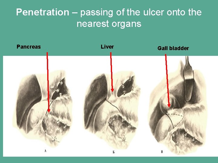 Penetration – passing of the ulcer onto the nearest organs Pancreas Liver Gall bladder