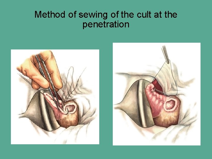 Method of sewing of the cult at the penetration 