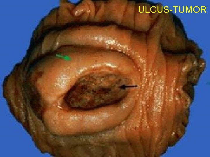 ULCUS-TUMOR 