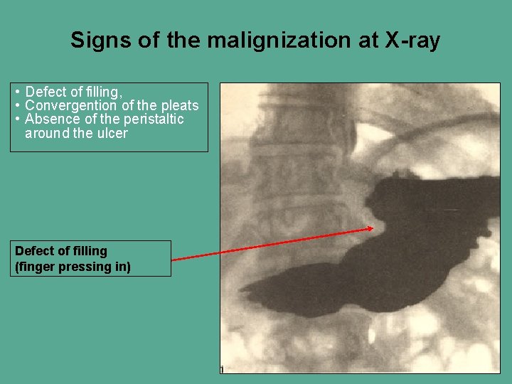 Signs of the malignization at X-ray • Defect of filling, • Convergention of the