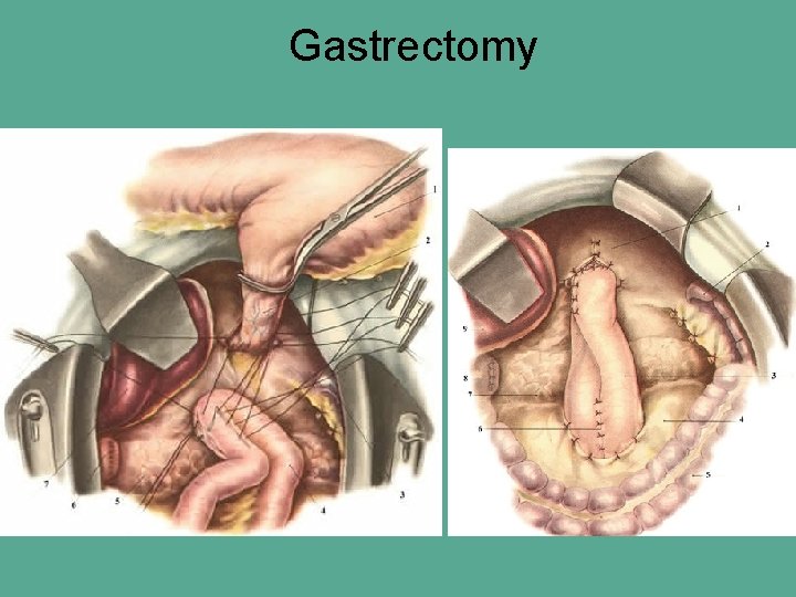 Gastrectomy 