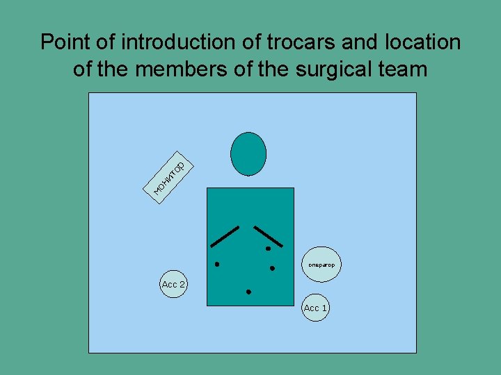 мо ни то р Point of introduction of trocars and location of the members