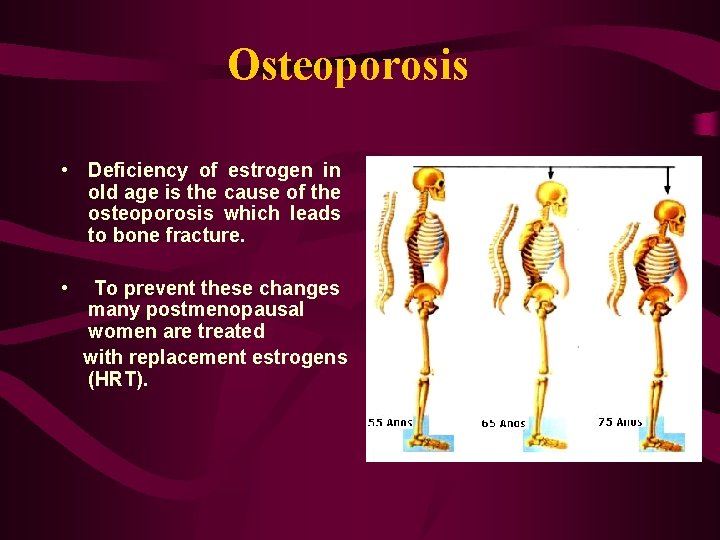 Osteoporosis • Deficiency of estrogen in old age is the cause of the osteoporosis