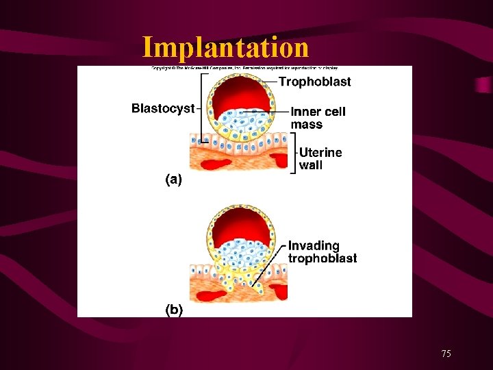 Implantation 75 