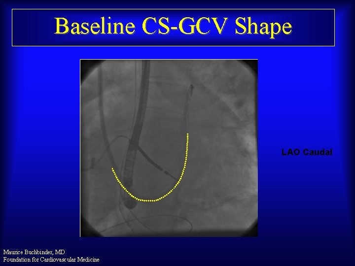 Baseline CS-GCV Shape LAO Caudal Maurice Buchbinder, MD Foundation for Cardiovascular Medicine 