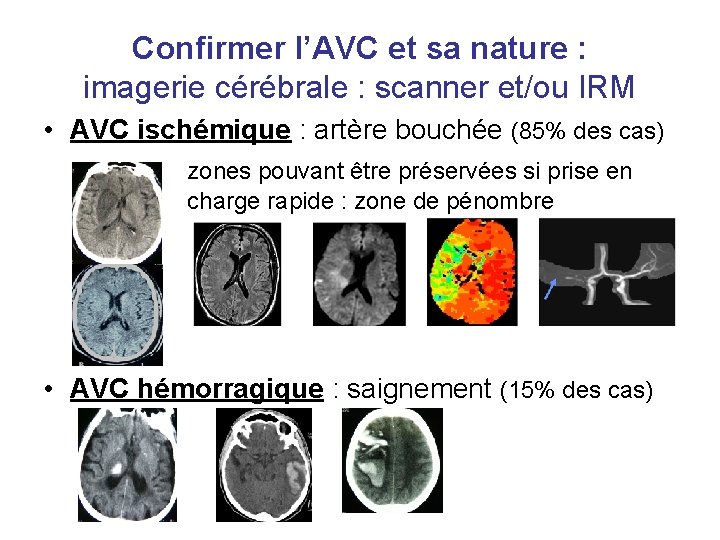 Confirmer l’AVC et sa nature : imagerie cérébrale : scanner et/ou IRM • AVC