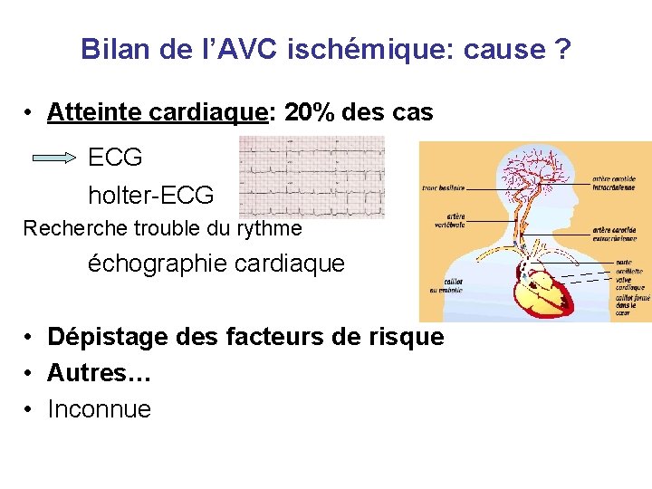 Bilan de l’AVC ischémique: cause ? • Atteinte cardiaque: 20% des cas ECG holter-ECG