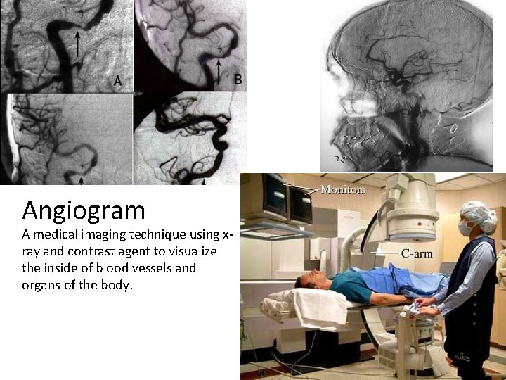 Angiogram A medical imaging technique using xray and contrast agent to visualize the inside