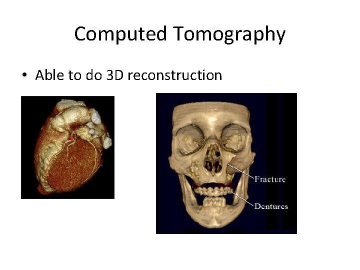 Computed Tomography • Able to do 3 D reconstruction 