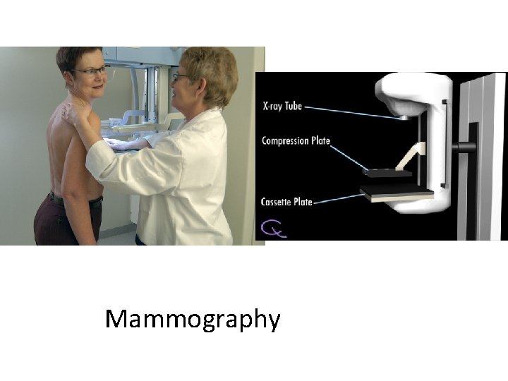 Mammography 