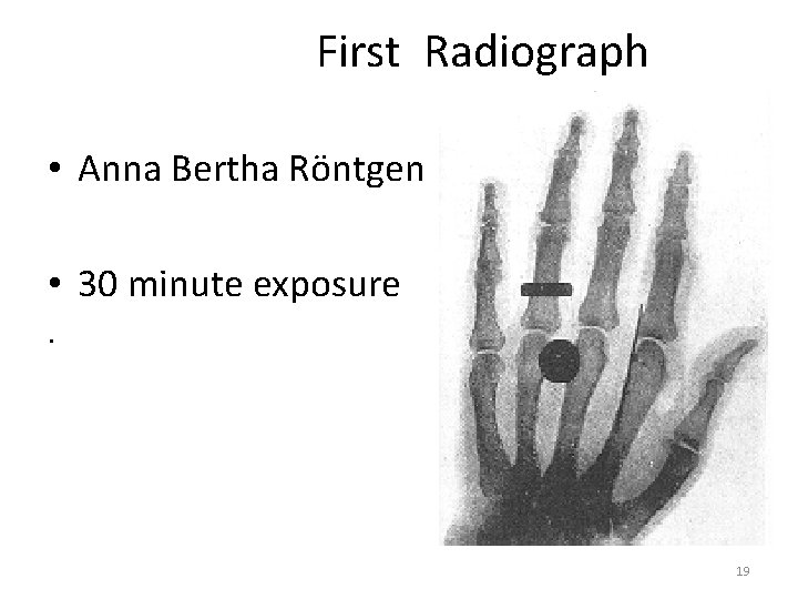 First Radiograph • Anna Bertha Röntgen • 30 minute exposure. 19 