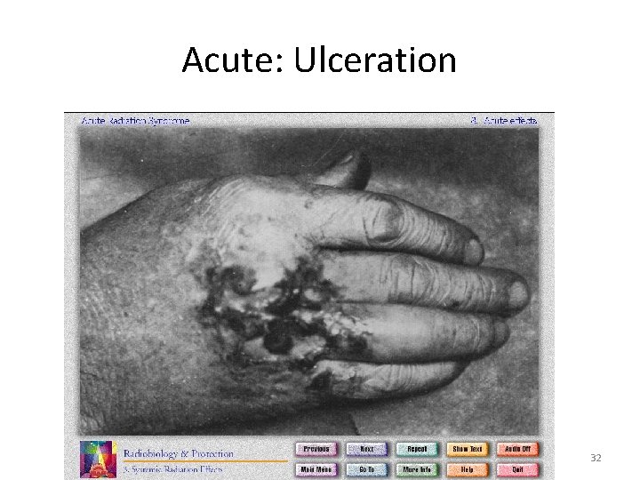Acute: Ulceration 32 