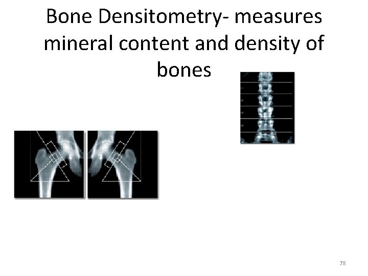Bone Densitometry- measures mineral content and density of bones 78 