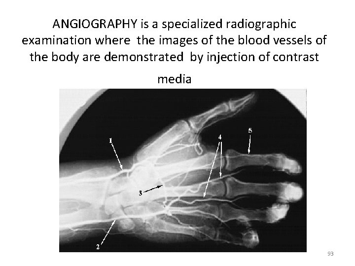 ANGIOGRAPHY is a specialized radiographic examination where the images of the blood vessels of