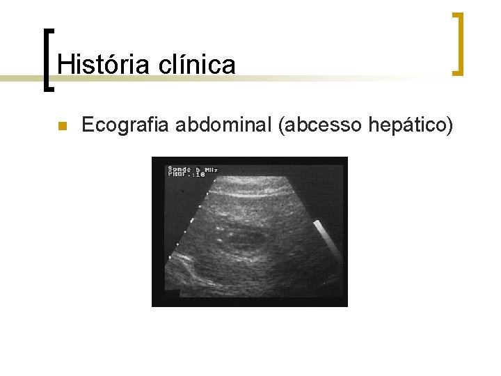 História clínica n Ecografia abdominal (abcesso hepático) 