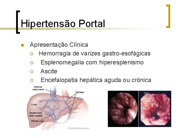 Hipertensão Portal n Apresentação Clínica ¡ Hemorragia de varizes gastro-esofágicas ¡ Esplenomegalia com hiperesplenismo