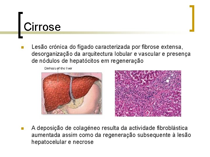 Cirrose n Lesão crónica do fígado caracterizada por fibrose extensa, desorganização da arquitectura lobular