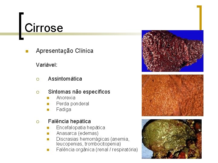 Cirrose n Apresentação Clínica Variável: ¡ Assintomática ¡ Sintomas não específicos n n n