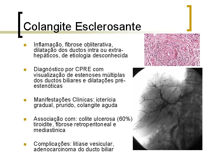 Colangite Esclerosante n Inflamação, fibrose obliterativa, dilatação dos ductos intra ou extrahepáticos, de etiologia