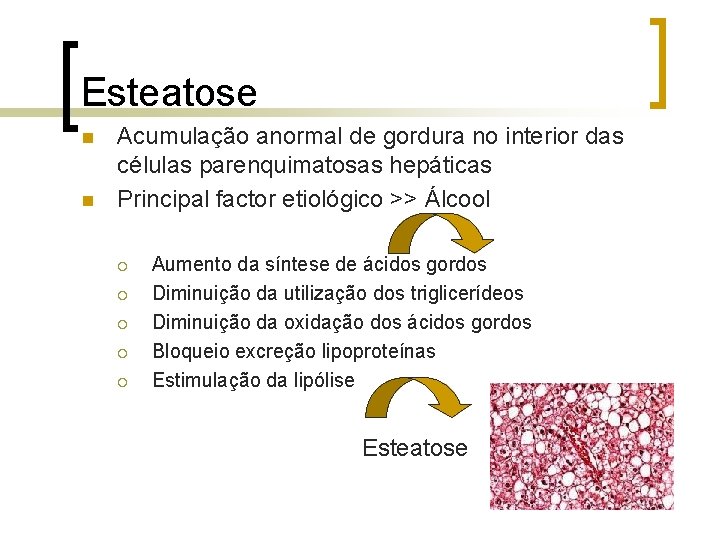 Esteatose n n Acumulação anormal de gordura no interior das células parenquimatosas hepáticas Principal