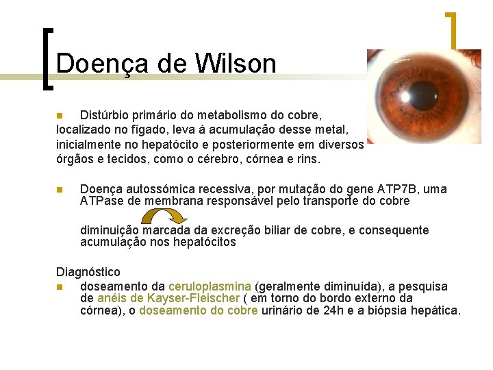 Doença de Wilson Distúrbio primário do metabolismo do cobre, localizado no fígado, leva à