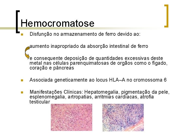 Hemocromatose n Disfunção no armazenamento de ferro devido ao: aumento inapropriado da absorção intestinal