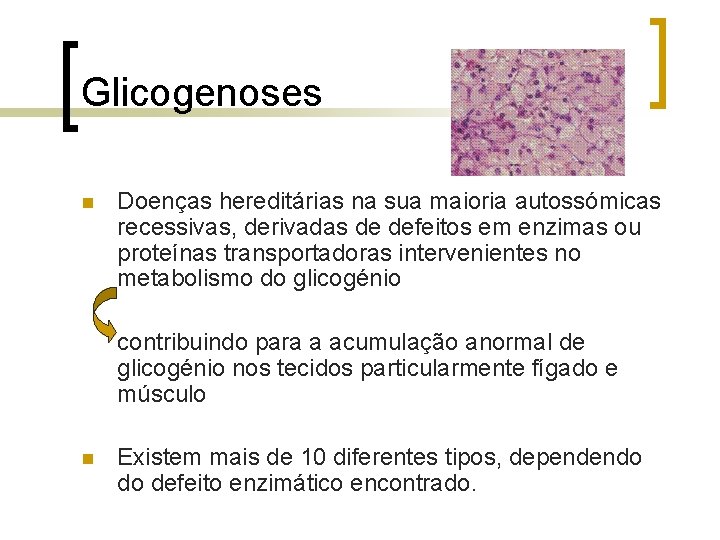 Glicogenoses n Doenças hereditárias na sua maioria autossómicas recessivas, derivadas de defeitos em enzimas