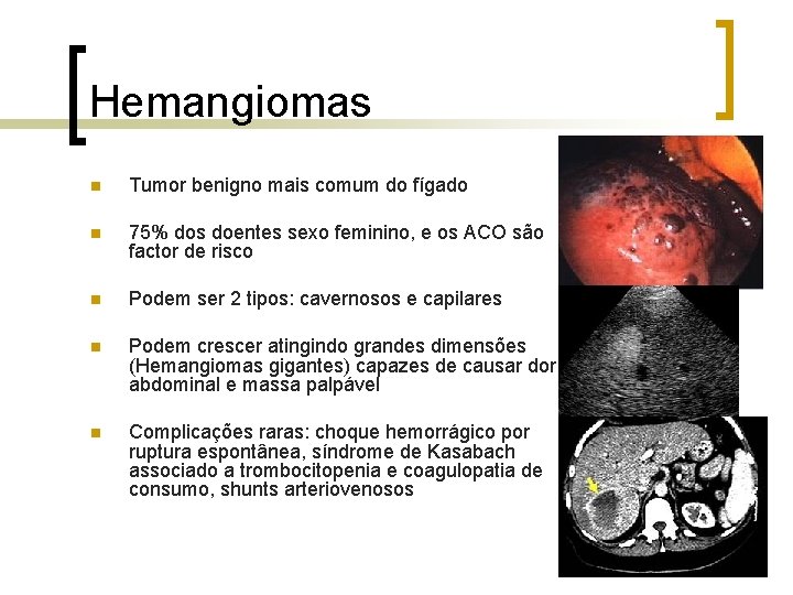 Hemangiomas n Tumor benigno mais comum do fígado n 75% dos doentes sexo feminino,