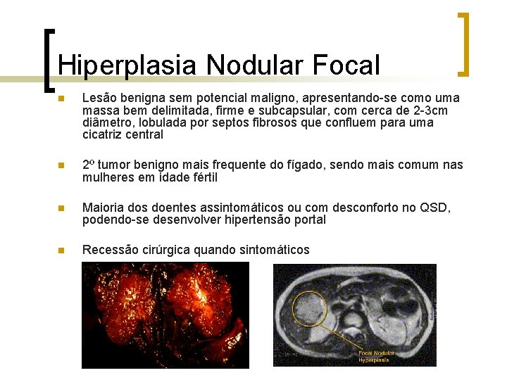 Hiperplasia Nodular Focal n Lesão benigna sem potencial maligno, apresentando-se como uma massa bem