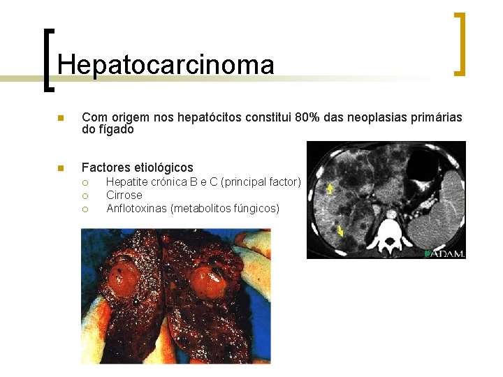 Hepatocarcinoma n Com origem nos hepatócitos constitui 80% das neoplasias primárias do fígado n