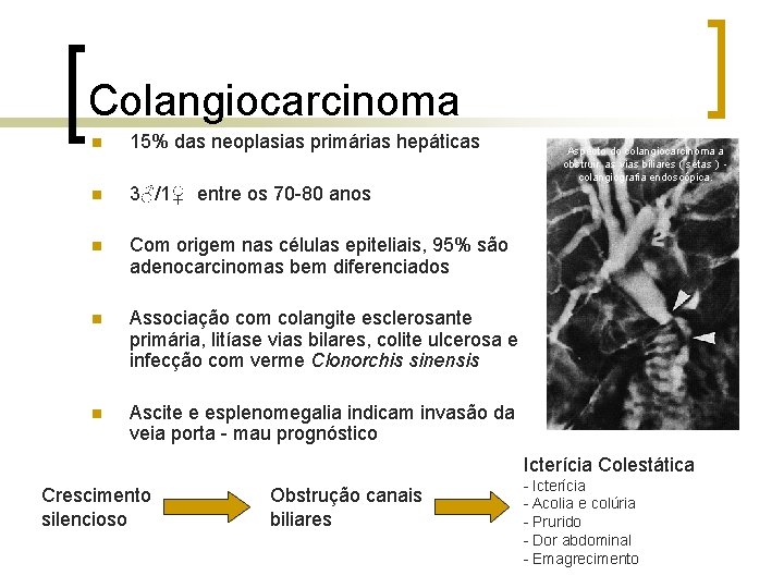 Colangiocarcinoma n 15% das neoplasias primárias hepáticas n 3♂/1♀ entre os 70 -80 anos