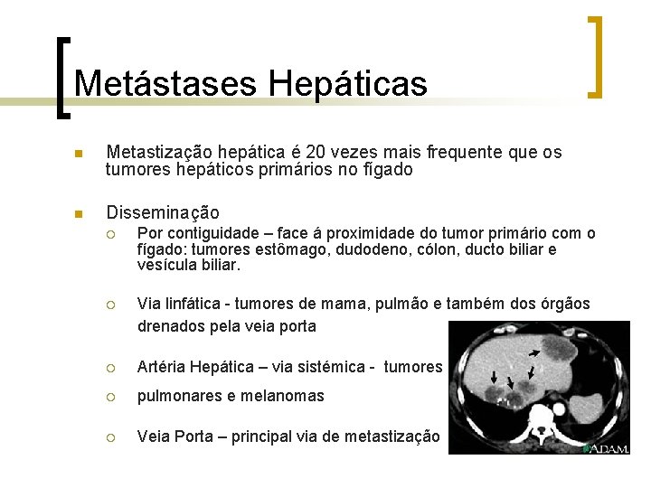 Metástases Hepáticas n Metastização hepática é 20 vezes mais frequente que os tumores hepáticos