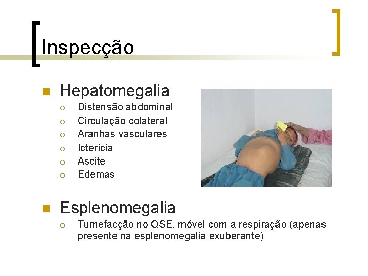 Inspecção n Hepatomegalia ¡ ¡ ¡ n Distensão abdominal Circulação colateral Aranhas vasculares Icterícia