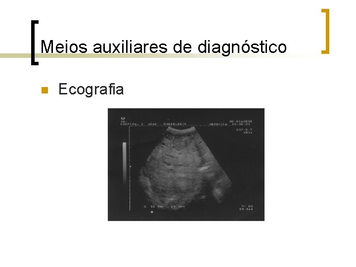 Meios auxiliares de diagnóstico n Ecografia 