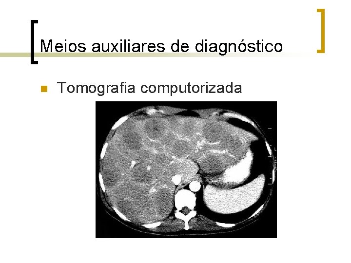 Meios auxiliares de diagnóstico n Tomografia computorizada 