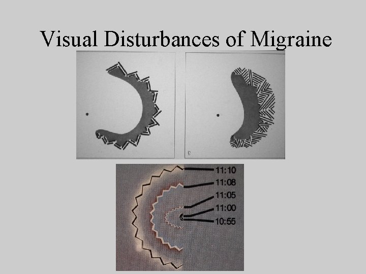 Visual Disturbances of Migraine 