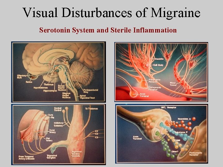 Visual Disturbances of Migraine Serotonin System and Sterile Inflammation 