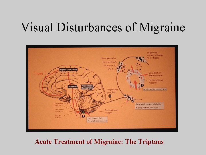 Visual Disturbances of Migraine Acute Treatment of Migraine: The Triptans 