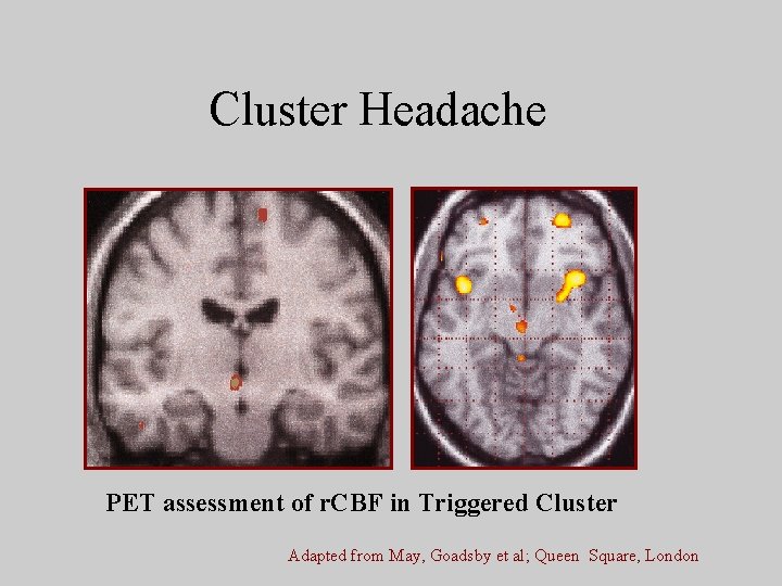 Cluster Headache PET assessment of r. CBF in Triggered Cluster Adapted from May, Goadsby