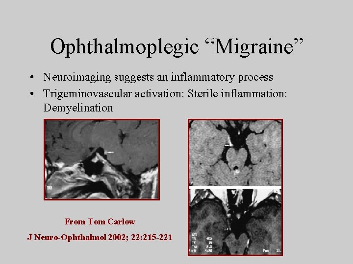 Ophthalmoplegic “Migraine” • Neuroimaging suggests an inflammatory process • Trigeminovascular activation: Sterile inflammation: Demyelination
